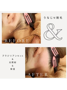 ユメバンチ(yumebanchi)/うなじW脱毛