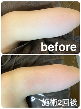 ギンザアール(GINZA R.)/すっきり二の腕に◎