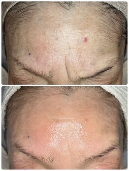 ルビー(RUBY)/諦めていたシワ改善