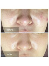 ノルン(Norn)/ニキビケア☆ハーブピーリング