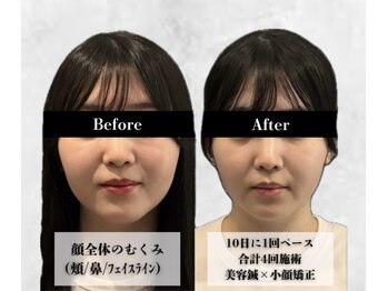 アロエ鍼灸整体院/美容鍼×小顔矯正|4回施術
