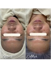 ビースキン(be-skin)/ララピール5回目！