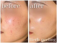 ルルラ リコ(lulula rico)の雰囲気（【お客様症例写真】様々なフェイシャルケアでお悩みを解消します）