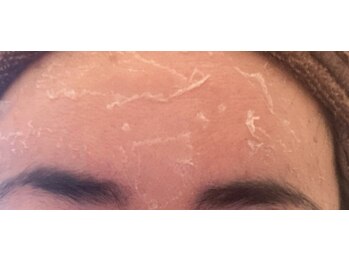 プレジール エテ(plaisir Ete)/人気のハーブピーリング【お顔】