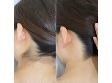 インベスト(INVEST)/うなじ脱毛