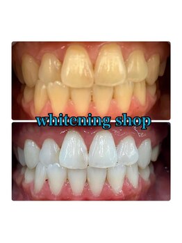 ホワイトニングショップ 所沢店/before&after美白ホワイトニング