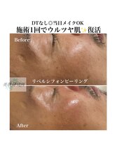 美肌研究所 東京新宿支店/剥けないピーリングでも一目瞭然