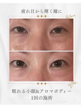 キラン 神戸店(Kiran)/疲れ目からくるクマを1回で解消