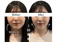 1回目から驚くべき変化量【小顔/美容鍼/心斎橋/エラ/むくみ】