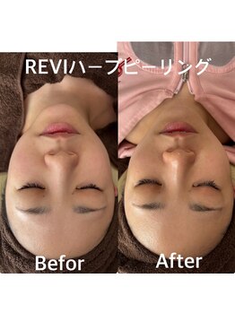 マヴィー(MAVIE)/REVIハーブピーリング