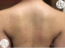 ハーバリー ハーブピーリング 栄(HERBERRYハーブピーリング)/ハーブピーリング専門店HERBERRY