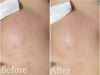 サージュクロレ 松戸店(sage colorer)/グロウハーブピーリング