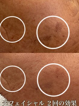 サロン ド マキ(Salon de Maki)/群馬県初導入の光フェイシャル☆