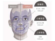 アイジー(iG)/たるみ予防フェイスリフティング