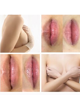 メディカルエース(MedicalAce)の写真/生まれたてのベビーピンクに♪【ROMA PINK ローマピンク】唇/バスト/脇/お尻/ひじ/ひざ等、全身対応可能！