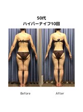 ビハダエステ 町田店(BIHADAエステ)/【B/A】50代ハイパーナイフ