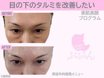 ぷるるんエステ/フェイシャル/小顔/毛穴