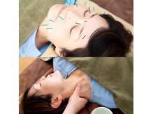 スクナビコナ鍼灸院の雰囲気（首肩こりの改善と美容鍼を組み合わせ、内側から輝く表情へ。）