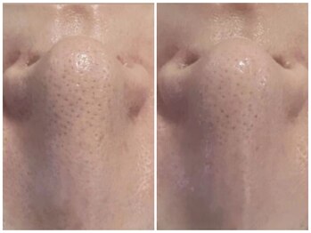 ブレス/Before→After