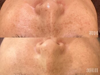 ウォーム(warm)/シミケア/美白/脱ピーリング