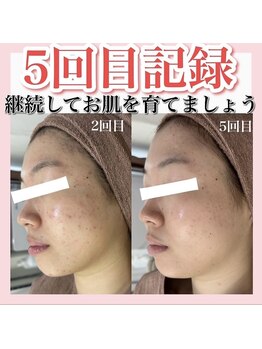 アルムダアクア 天王寺店(Aleumda AQUA)/大阪/天王寺/ハーブピーリング