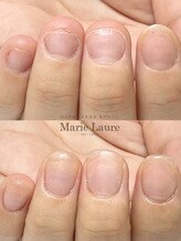 マリーロール 梅田店(Marie Laure)/自爪育成/深爪矯正/ネイルケア