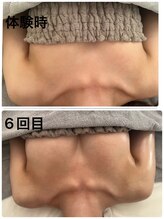 美人バスト 浜松店/◆バストアップ &nbsp;BeforeAfter◆