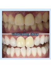 ホワイトニングショップ 柏店/差し歯の方もホワイトニングケア