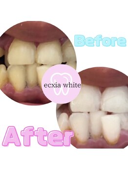 エクシアホワイト 広島袋町店/ホワイトニングビフォーアフター