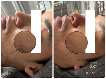 ルクシア(RUXCIA)/毛穴洗浄サーマルフラクショナル