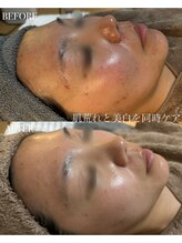 ソア/【肌質改善】ハーブピーリング