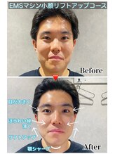 ヒーレンス(HEALENCE)/EMS小顔30分でここまで変わる！