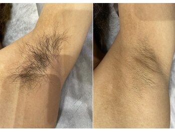 ビオプラス(BIO PLUS)/【脱毛】ワキ脱毛ニオイ対策にも