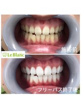 ルブラン 奈良店(Le Blanc)/なんと美しい歯！！