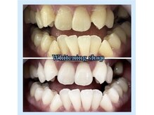 ホワイトニングショップ 柏店/どんな歯でもOKなホワイトニング