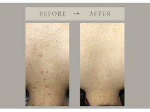 フェリチタトウキョウ(Felicita Tokyo)/【美肌脱毛】全身