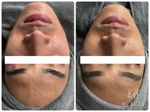 ルクシア(RUXCIA)/毛穴洗浄サーマルフラクショナル