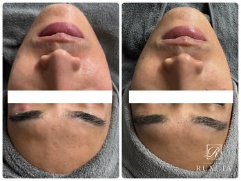 ルクシア(RUXCIA)/毛穴洗浄サーマルフラクショナル