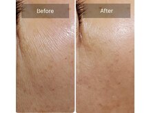 テセラ(TETHERA)/ナノテクノロジーフェイシャル