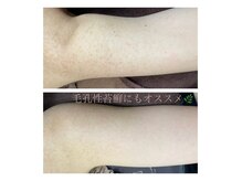 エミルカ 新宿(EMILUCA)の雰囲気（ハーブピーリングで背中・顔・二の腕・お尻綺麗になります★）