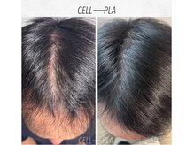 施術回数４回/新メニューのセルプラは頭皮のお悩みを改善