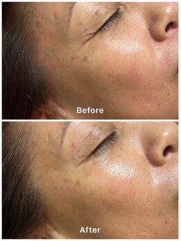 エビスラボ(Ebisu Labo)/乾燥肌（シワ）対策