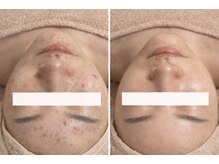 ルネル(Lunelle)/剥離なしのハーブピーリング