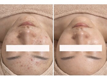 ルネル(Lunelle)/剥離なしのハーブピーリング