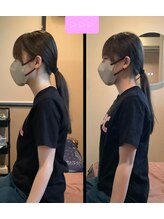 楓整骨院/姿勢矯正Befre・After