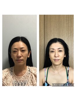 マカニ 河原町御池(makani)/小顔矯正ビフォーアフター