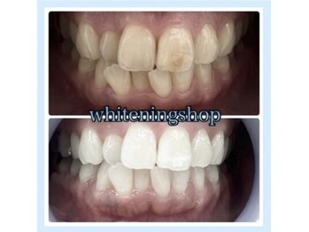 ホワイトニングショップ 柏店/長年の着色汚れもスッキリ♪