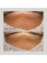 アデル 久留米(ADEL)/《全顔》おでこワックス