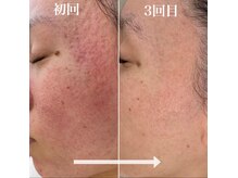 シルクナ(silkn)の雰囲気（本気の肌質改善！ハッキリ言って効果絶大です。）