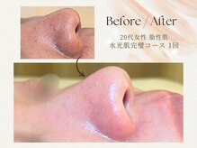 アミリオン(amillion)の雰囲気（ニキビや肌荒れのお悩みも、根本解決は毛穴詰まりの見直しから！）